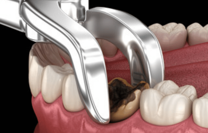 What You Need To Know About Tooth Extraction