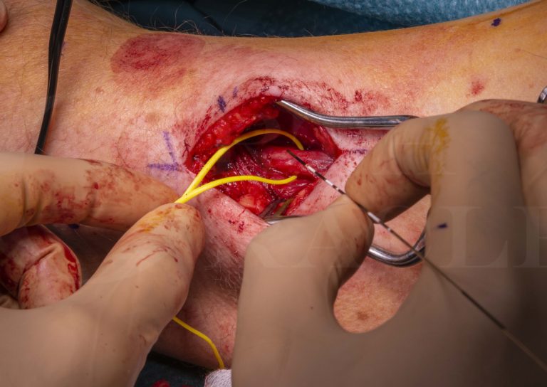 What You Should Know About Peripheral Nerve Surgery