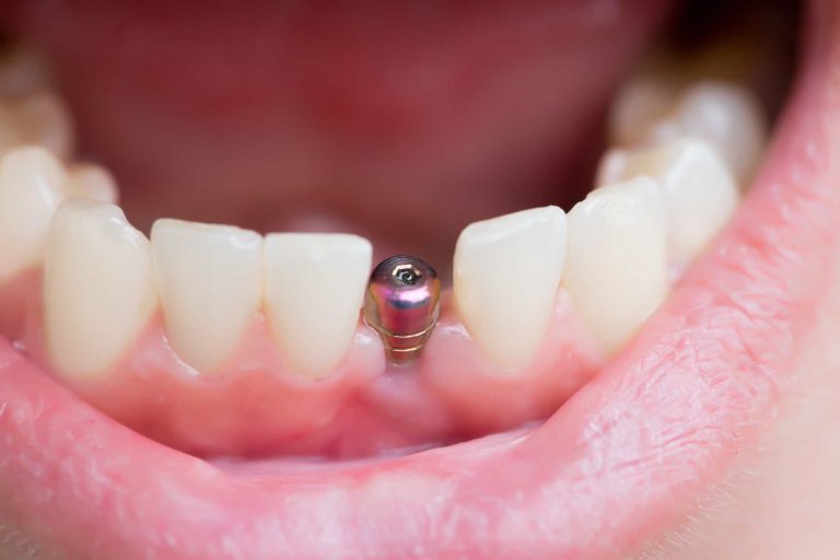 Five Ways You Can Boost Your Dental Implants Recovery