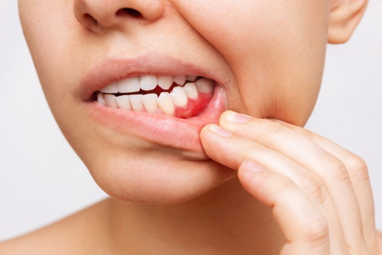 Tips to Prevent Gum Disease