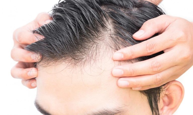 Common Causes of Hair Loss In Men