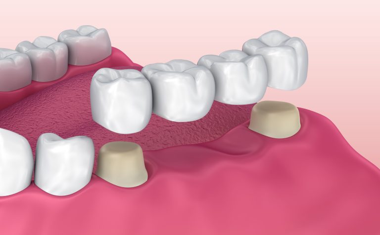 Aftercare Tips for Dental Bridges