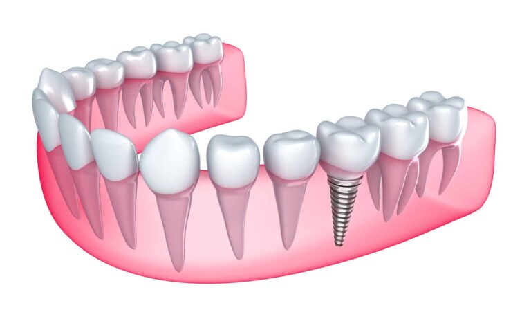 Implant Dentistry and the Importance of Tooth Replacement.